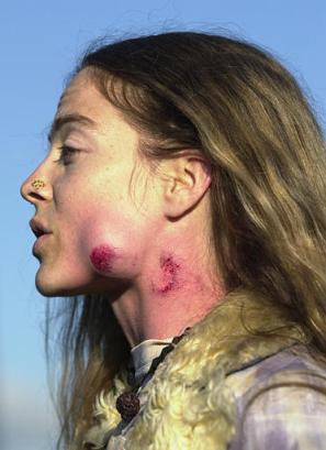 A protestor, who refused to give her name, bears the wounds after she says was hit by Oakland police weapon during a anti-war protest in Oakland, Calif., Monday, Aug. 7, 2003 outside the port area. (AP Photo/Paul Sakuma)  